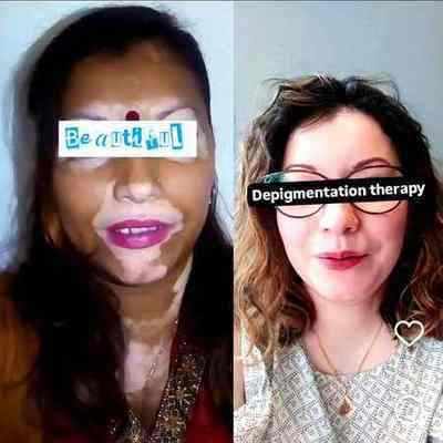 Vitiligo depigmentation therapy before after monobenzone results