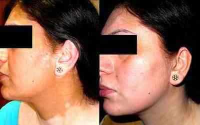 Vitiligo before after monobenzone cream depigmentation treatment results