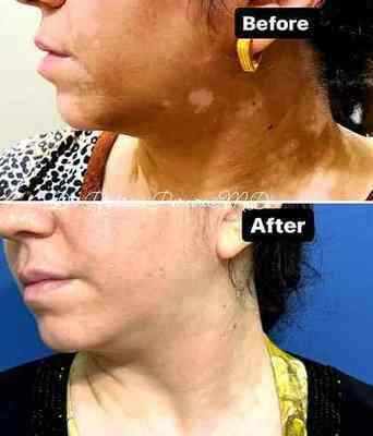 Vitiligo before and after monobenzone cream treatment face neck